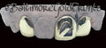10k Gold 2 Solid 1 Open Face Slash w/ Back Bridge image 0