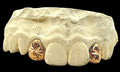 2 Gold Teeth: 10k Sunshine Cutz W/Back Bridge image 0