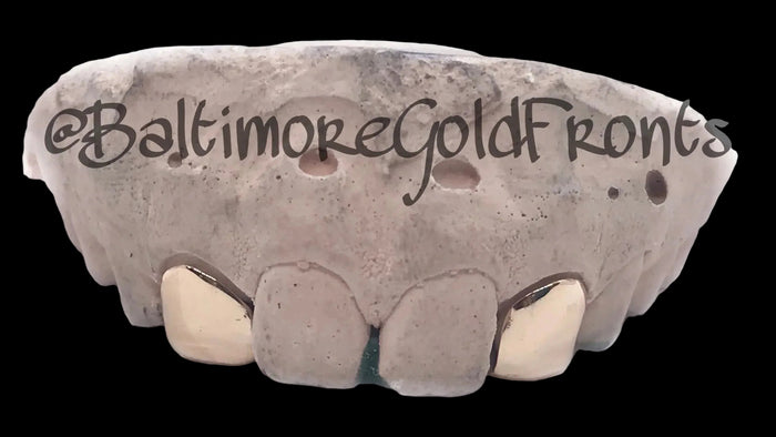 2 Gold Teeth: 2 Incisors And a Back Bridge image 0